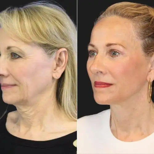 Crema Antiarrugas + 🎁 Serum Reafirmante™ El DUO que está revolucionando el cuidado facial
