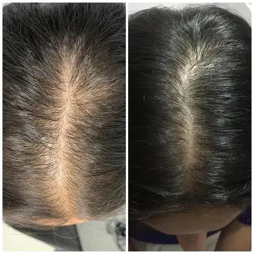 Dermatólogo experto revela método clínico para detener la caída del cabello en 21 días, sin medicamentos ni trasplantes. KIT SUERO+🎁SHAMPÚ DE BATANA™