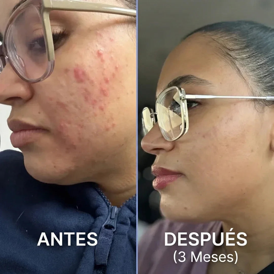 CLEARSTEM™ Creado para combatir el Acné Hormonal, Diseñado para que recuperes tu piel y tu autoestima.