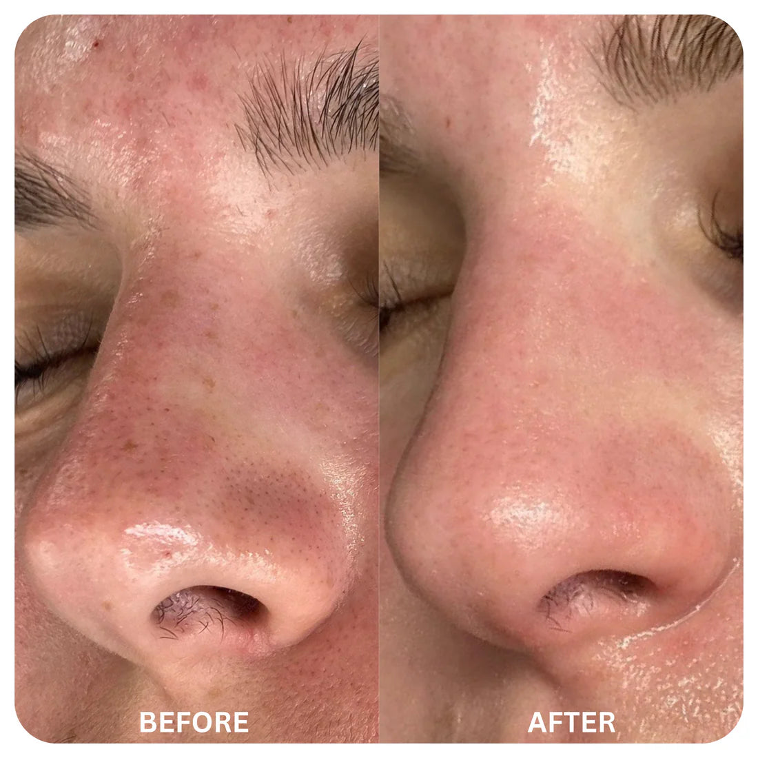 Lanbena®: Mascarilla avanzada  de puntos negros + 60 hojas