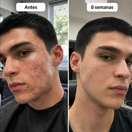 Barra de silicona de grado médico para cicatrices™🎁¡HOY EN OFERTA RECIBE 2 BARRAS!