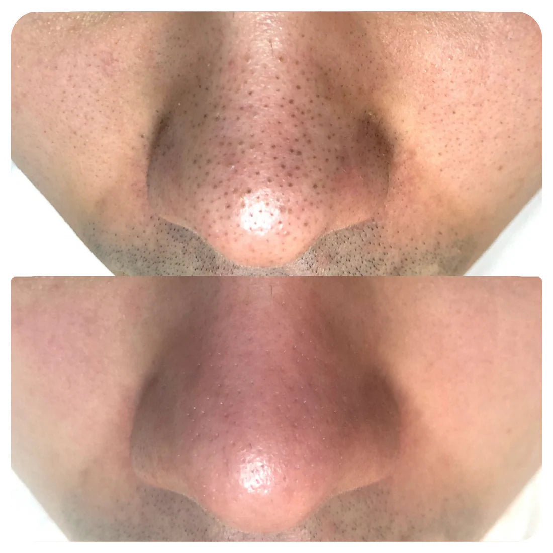 Lanbena®: Mascarilla avanzada  de puntos negros + 60 hojas