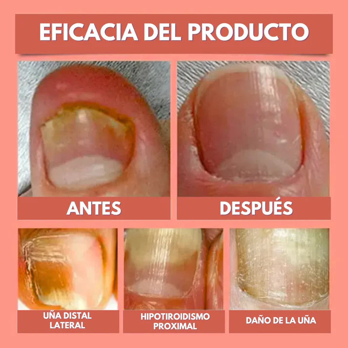 PureSkin 360™ Parches Antihongos - Eliminan Hongos y Regenera tus uñas